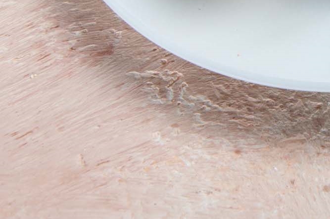 Smooth Bulging Under-Eyes with Lower Blepharoplasty for Middle-Aged Eyes image 23