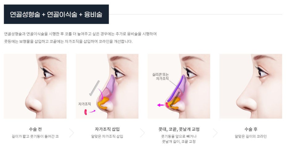 서울 코성형 짧은코 내 얼굴 비율에 맞게 관련 이미지 6