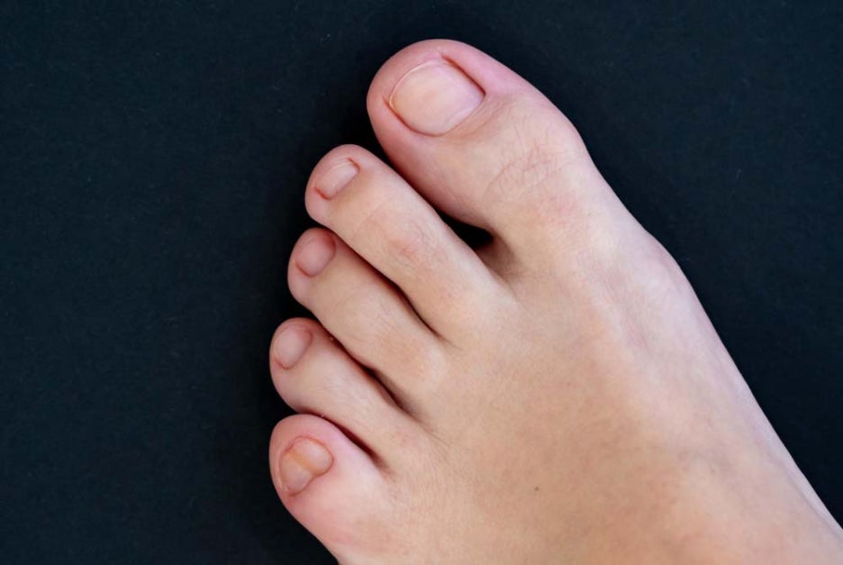 What Causes Big Toe Swelling and Pain? Are These Early Symptoms of Gout? image 4