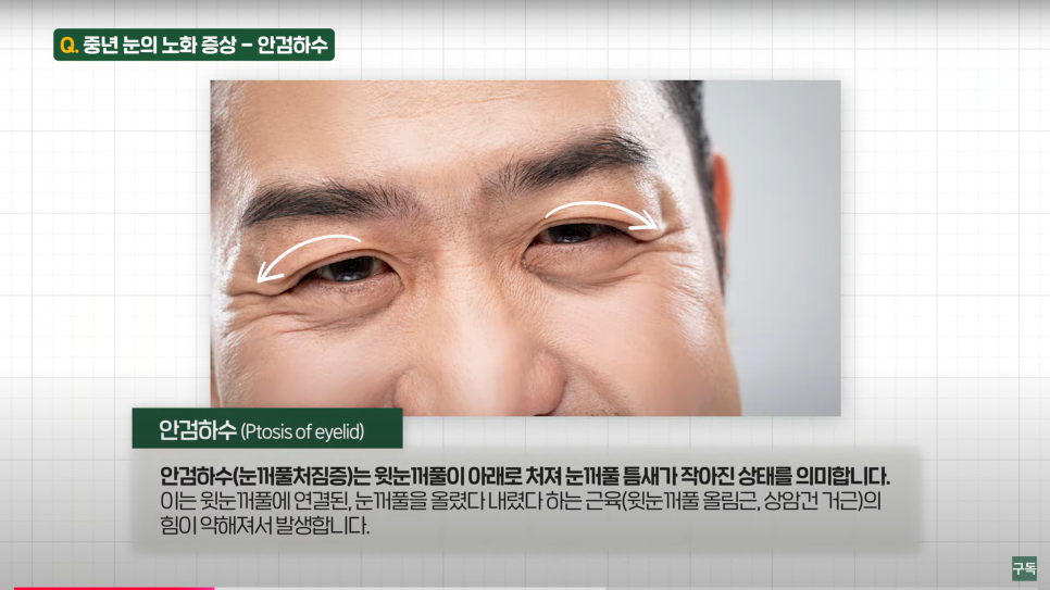How Much Scarring Is Left After an Eyebrow Lift for Drooping Eyes? image 3