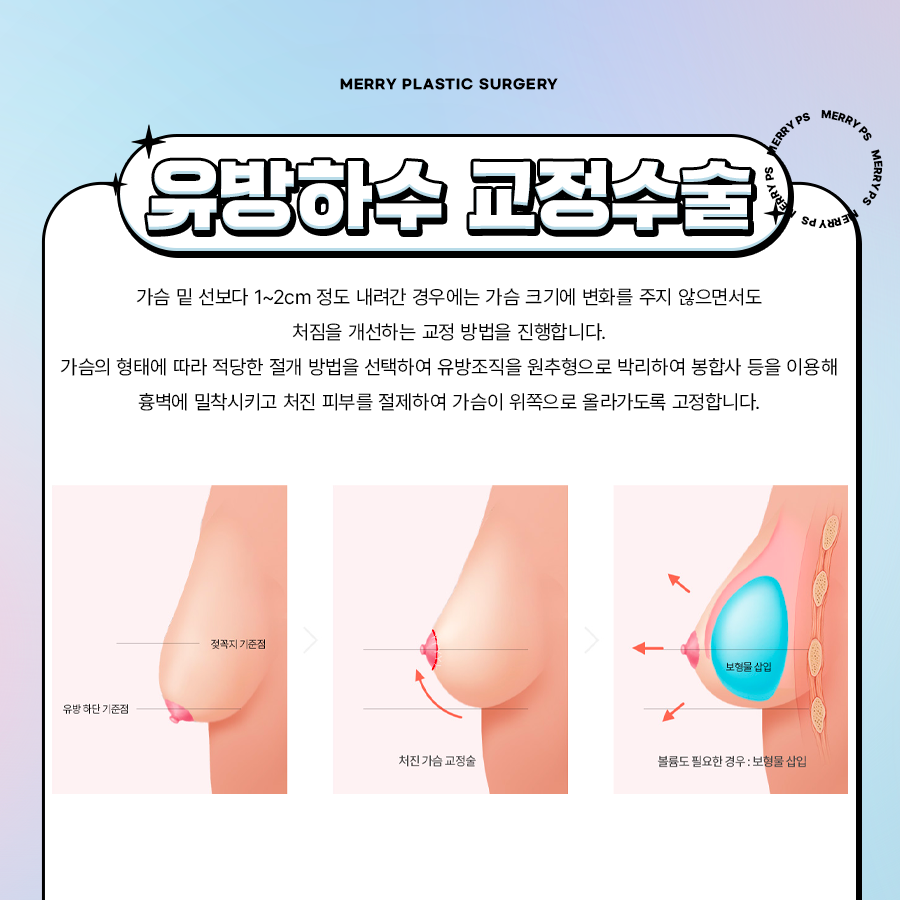 유방하수 교정수술 출산 후 처진 가슴 고민이라면 관련 이미지 5