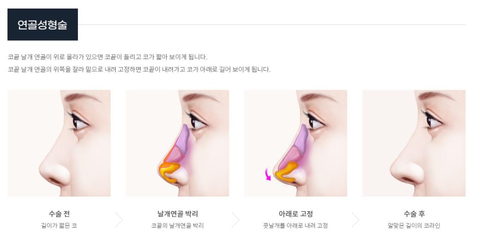 서울 코성형 짧은코 내 얼굴 비율에 맞게 관련 이미지 4