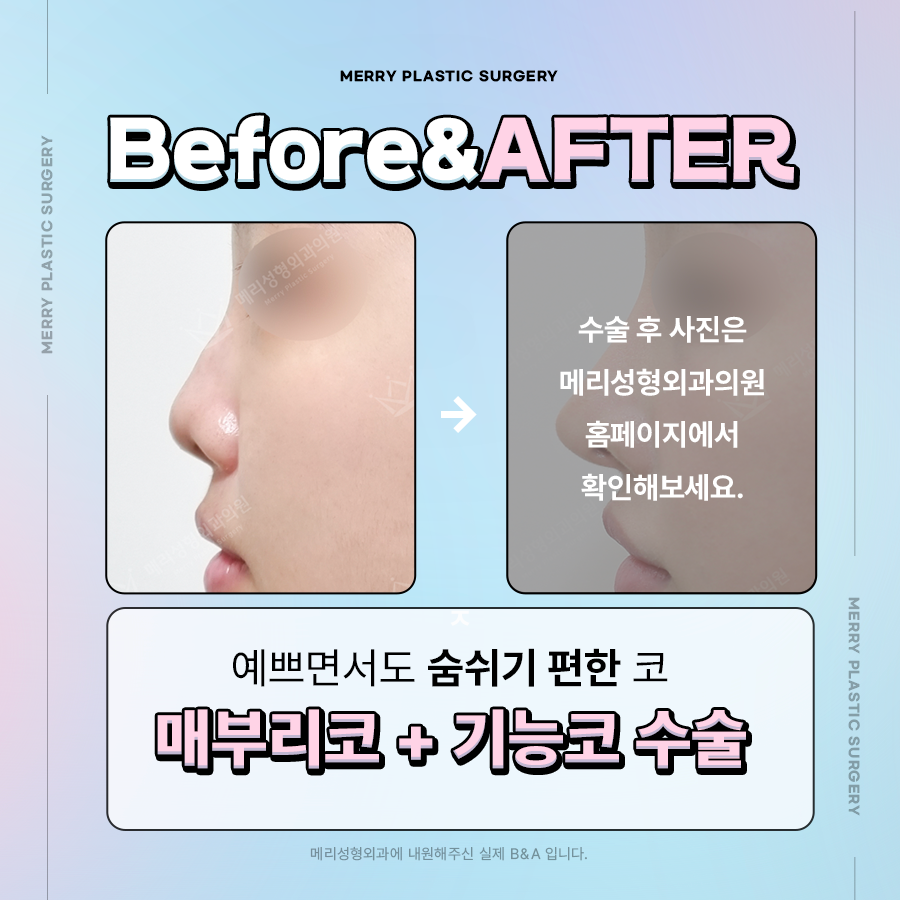 압구정 기능적 코성형 질환과 예쁜 코 모양을 동시에 관련 이미지 4
