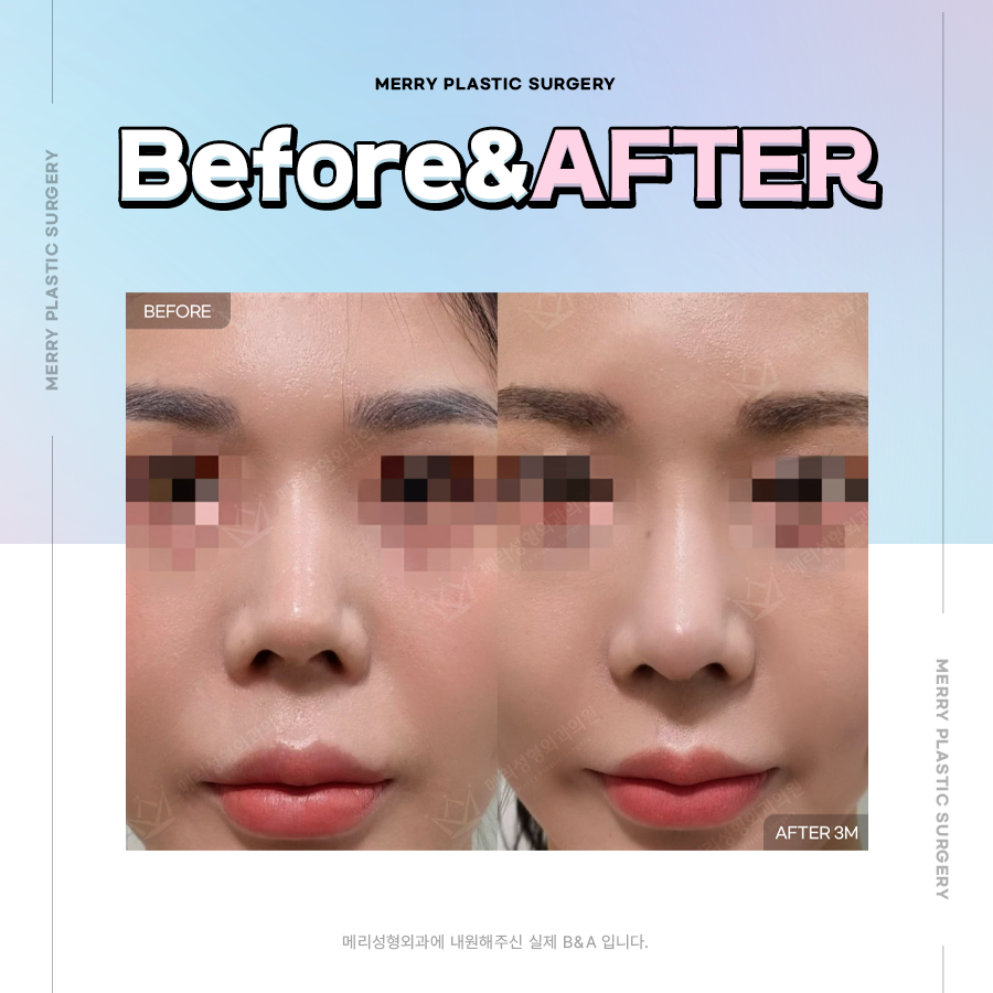 이물질 제거 코 성형 깔끔하게 이물질 제거하도록 관련 이미지 6