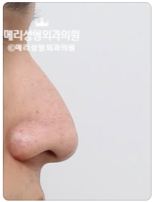Non-Implant Hump Nose Correction :: A Natural Change Without Implants, Making Breathing Comfortable Too image 4