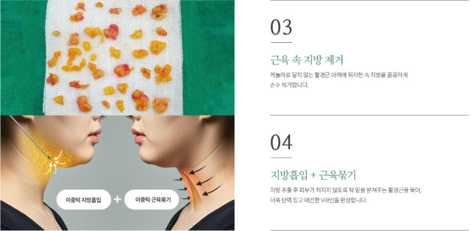 If Your Double Chin Still Looks Layered Even After Losing Weight? Mary Double Chin Zero Surgery, More Certain Than Prison Detox image 8