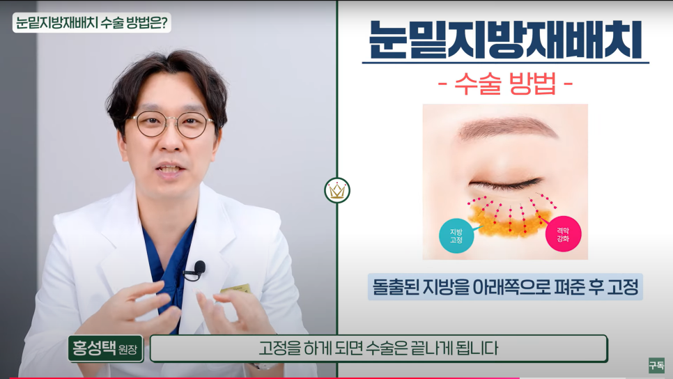 Tired of Hearing That Dark Circles Make You Look Older? Solve It with Just One Surgery image 3