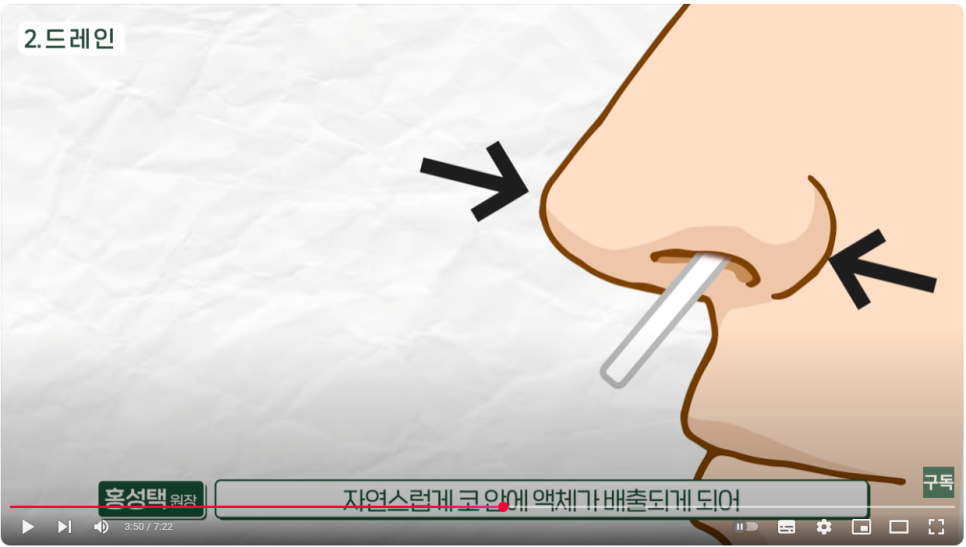 Post-Rhinoplasty Care :: When to Remove the Splint and Tape, Wound Care, and Nasal Congestion image 3