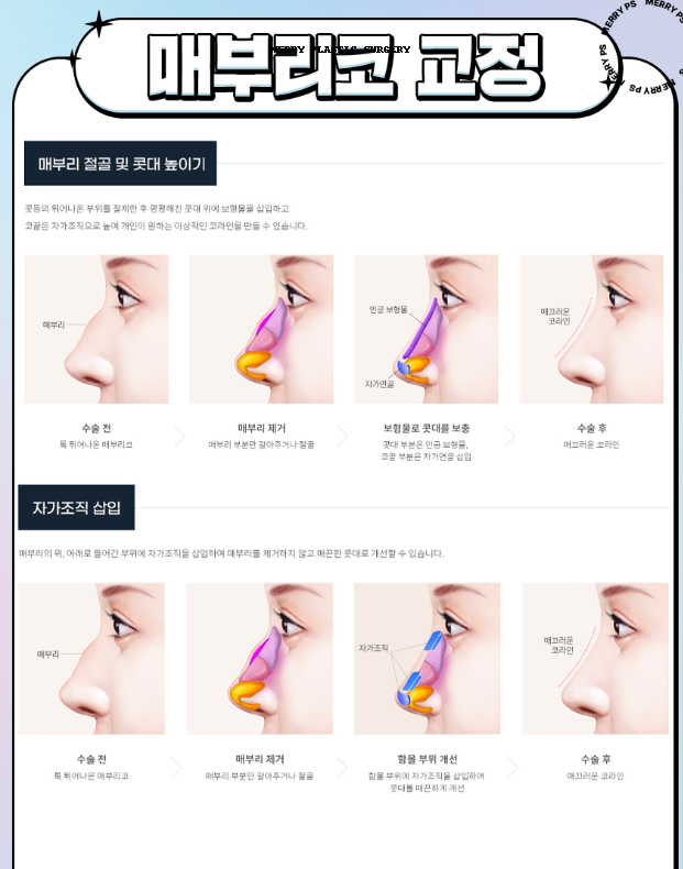 매부리코 수술 :: 압구정 성형외과에서 코재수술, 수술 후 관리, 수술 효과 관련 이미지 3