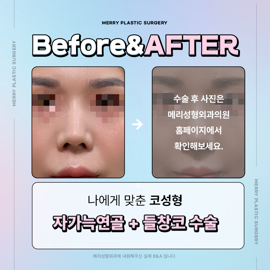 자가늑연골 코성형 후기와 방법 살펴봐야 하는 이유 관련 이미지 5