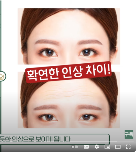Self-Diagnosis for Brow Ptosis :: Do I Need Lifting or Surgery? image 2