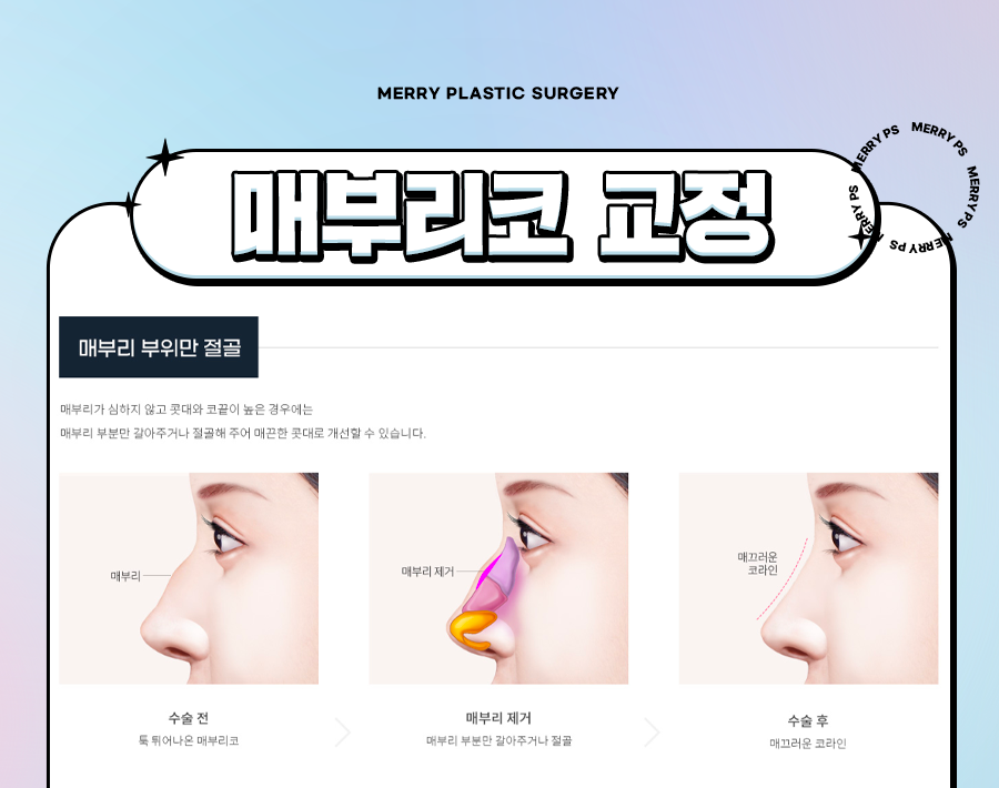 신사 매부리코 교정수술, 굴절 정도에 따라 맞춤형으로 관련 이미지 4