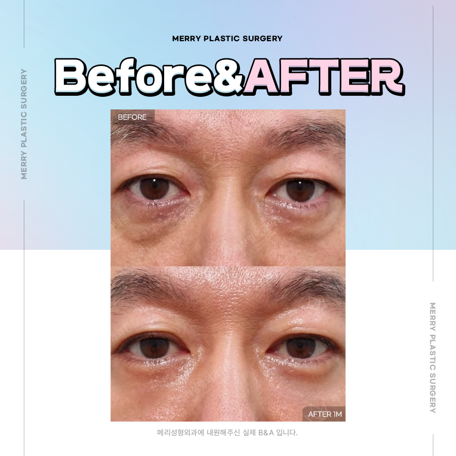 If You Want Clearer Eyes, Consider Lower Eyelid Sagging Lifting Surgery image 4