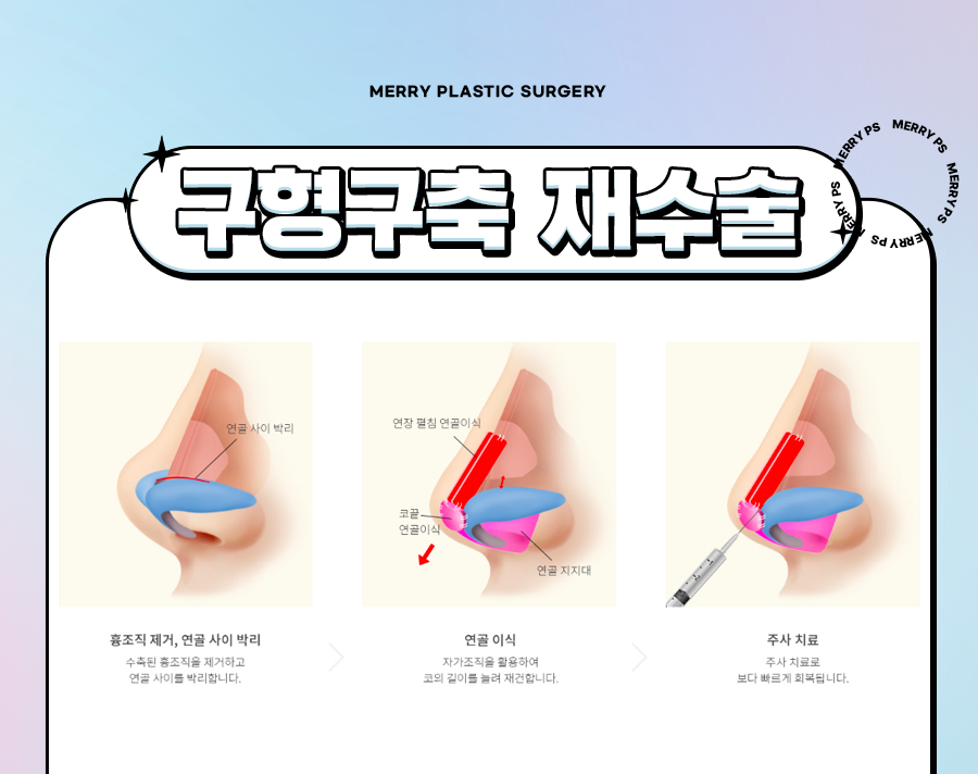 메리 구축 코 재수술 원인 찾아 다시 발생하지 않도록 관련 이미지 3