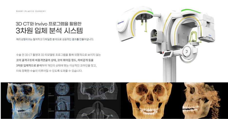압구정 메리성형외과 구축코 재수술로 다시 자연스럽게 관련 이미지 7