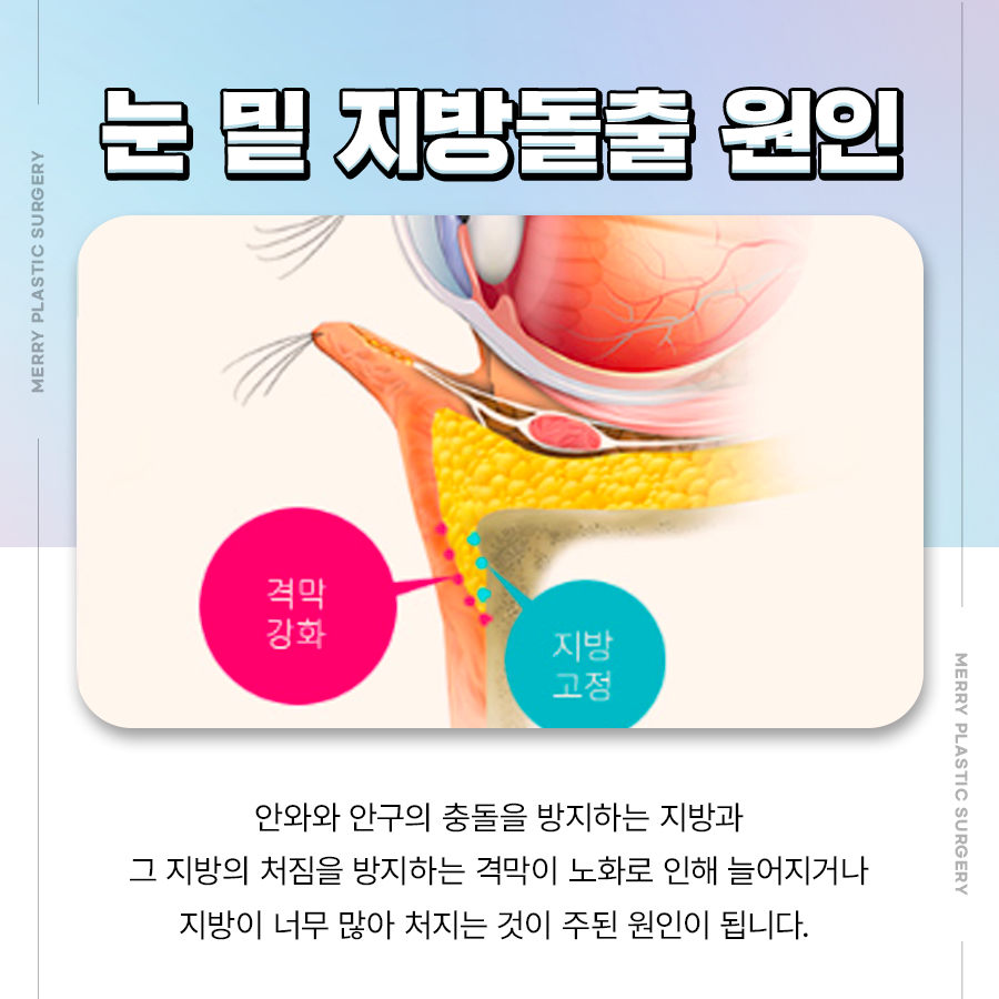 눈 밑 지방돌출 원인 파악하여 부작용 걱정 없는 재배치해요 관련 이미지 2