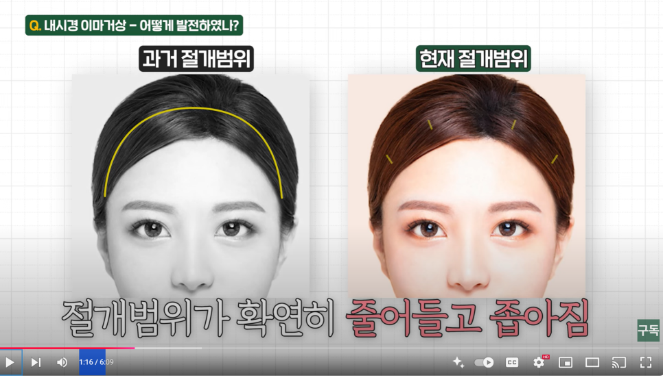 내시경 이마 거상수술을 하면 이마가 넓어질까? 관련 이미지 3