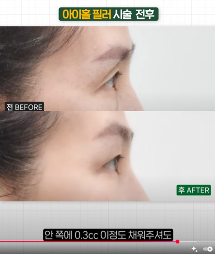 Sunken Upper Eyelids, Eye Hollow :: Filling with Filler, Side Effects, Drooping Eyelids, Gubonseung’s Sunken Upper Eyelids, Lee Dong-wook’s Eye Hollow, Double and Triple Eyelids image 8