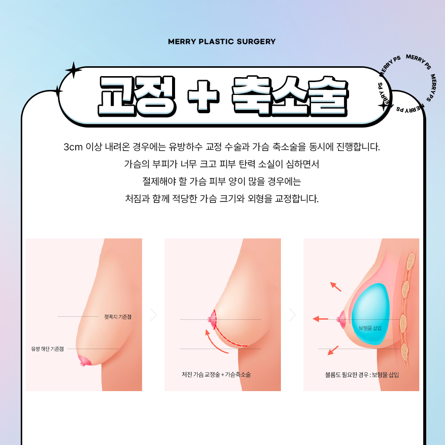 유방하수 교정수술 출산 후 처진 가슴 고민이라면 관련 이미지 6