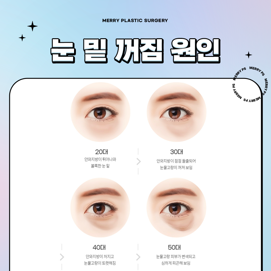 압구정 다크서클 수술, 눈 밑 그늘 유형에 따라서 관련 이미지 3