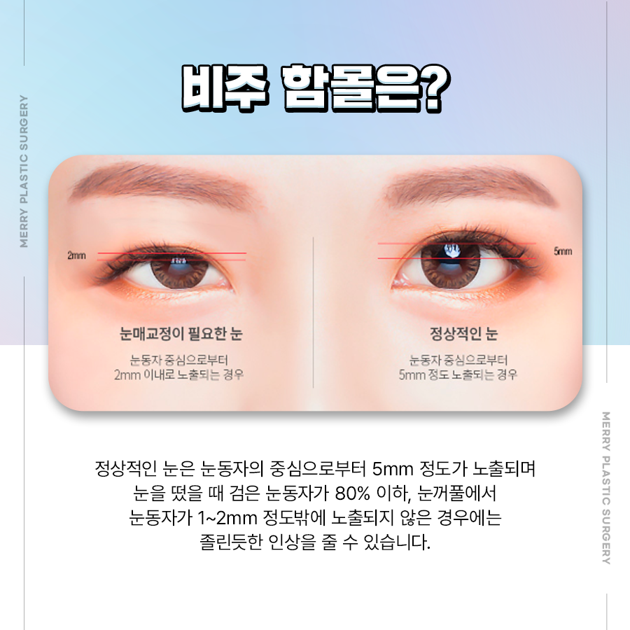 Making It Easier to Open the Eyes at Apgujeong Station for Sleepy-Eyed Correction image 4