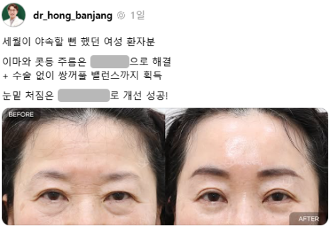 이마와 콧등 가로주름이 고민이세요? 점점 쌍커풀라인이 내려와서 쌍수를 고민중이시라면 이 사진을 꼭 보세요. 관련 이미지 1