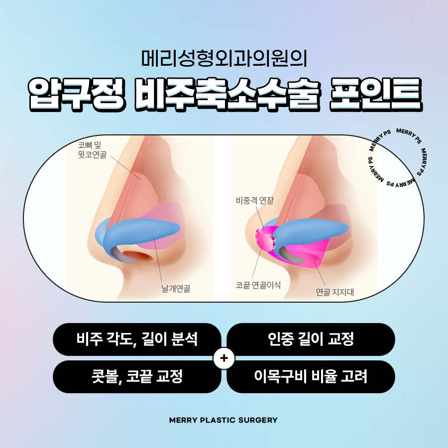 압구정 비주축소수술 인중 길이도 생각해서 관련 이미지 4