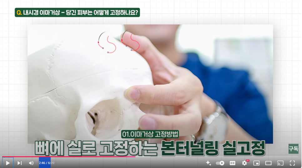내시경 이마 거상수술을 하면 이마가 넓어질까? 관련 이미지 4