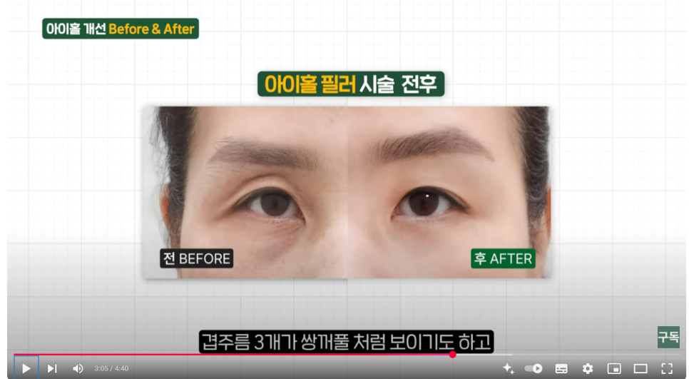 Sunken Upper Eyelids, Eye Hollow :: Filling with Filler, Side Effects, Drooping Eyelids, Gubonseung’s Sunken Upper Eyelids, Lee Dong-wook’s Eye Hollow, Double and Triple Eyelids image 7