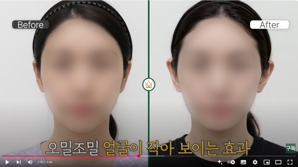 귀필러 :: 얼굴을 작아보이게 하는, 윤곽수술을 한듯한 착시효과, 귀필러 방법, 유지기간, 주의사항 관련 이미지 8