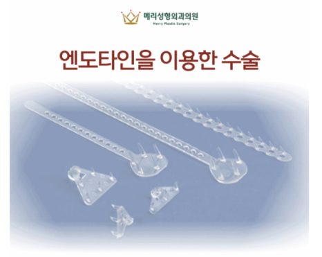 메리이마거상 :: 내시경을 이용한 이마거상술, 차이점과 흉터, 수술 내용까지 정리해봐요. 관련 이미지 4