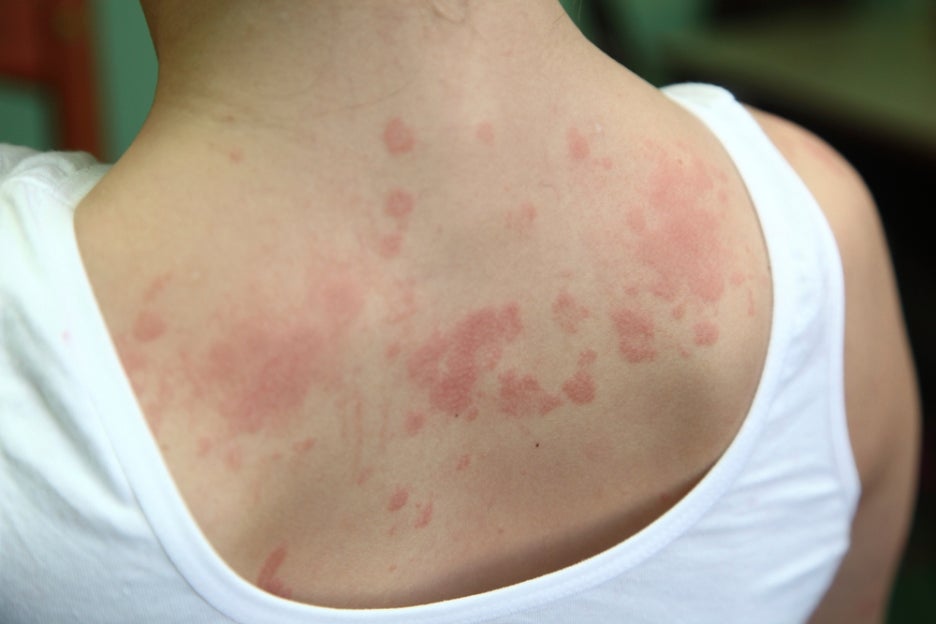 Summer Skin Conditions: How Can They Be Prevented and Treated? image 3
