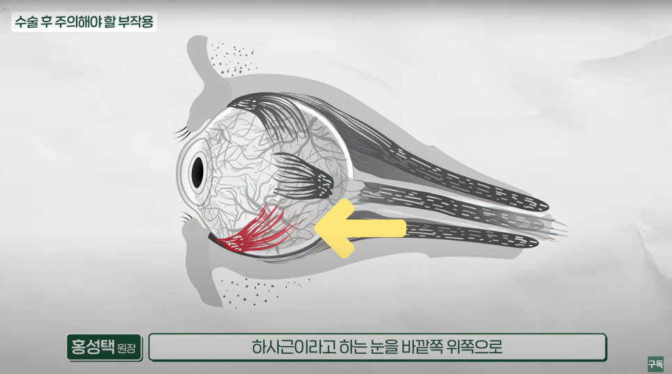 하안검 수술 후 출근은 언제 할 수 있을까? 관련 이미지 4