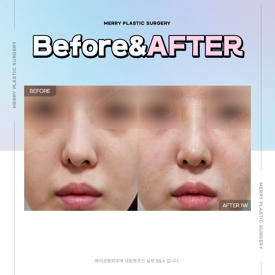 메리 구축 코 재수술 원인 찾아 다시 발생하지 않도록 관련 이미지 5