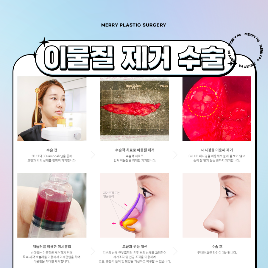 코성형 부작용 재수술로 염증 반응도 꼼꼼히 제거해요 관련 이미지 3
