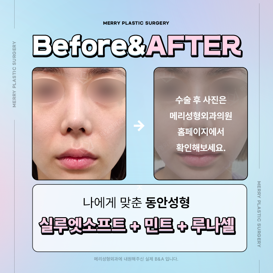 신사역 실루엣소프트 잘하는곳 볼륨감과 탄력감을 동시에 관련 이미지 4