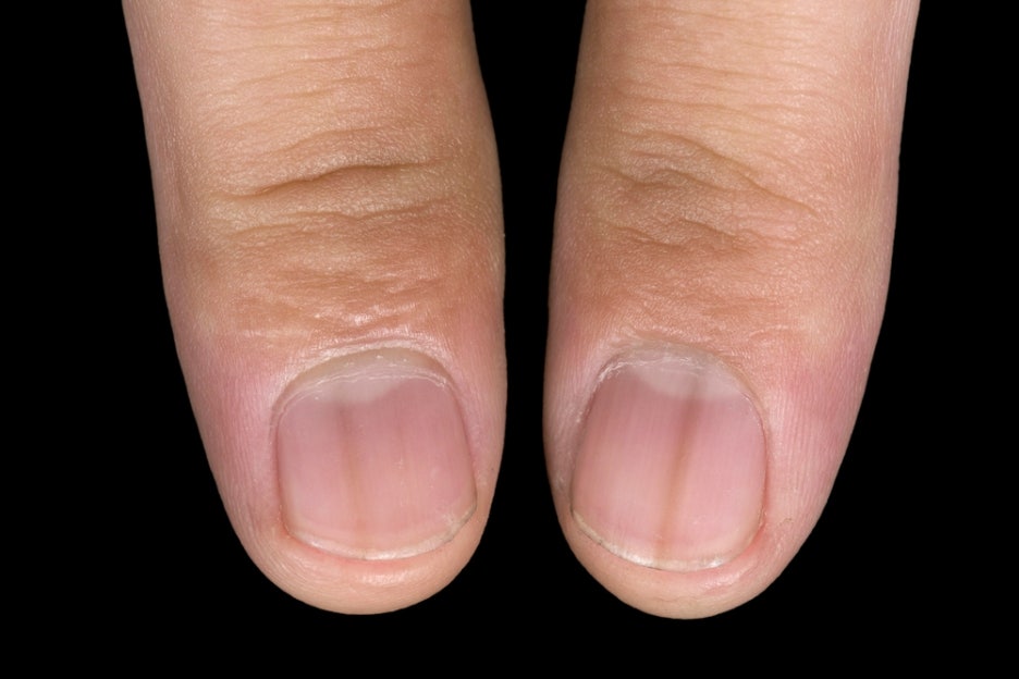 Why Do Black Vertical Lines Appear on Nails? What Health Problems Can Nail Colors Indicate? image 3