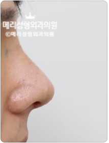 Non-Implant Hump Nose Correction :: A Natural Change Without Implants, Making Breathing Comfortable Too image 5