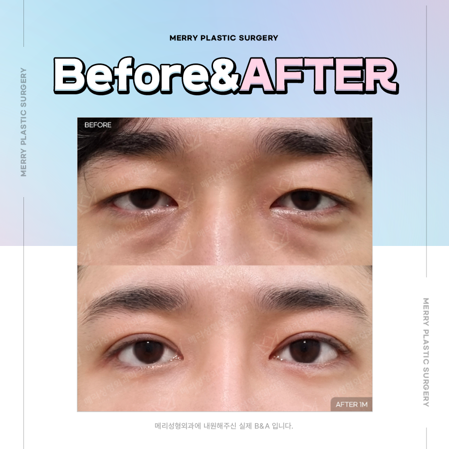 신사동 눈밑지방재배치 연령대별로 다른 원인과 증상에 따라 관련 이미지 5