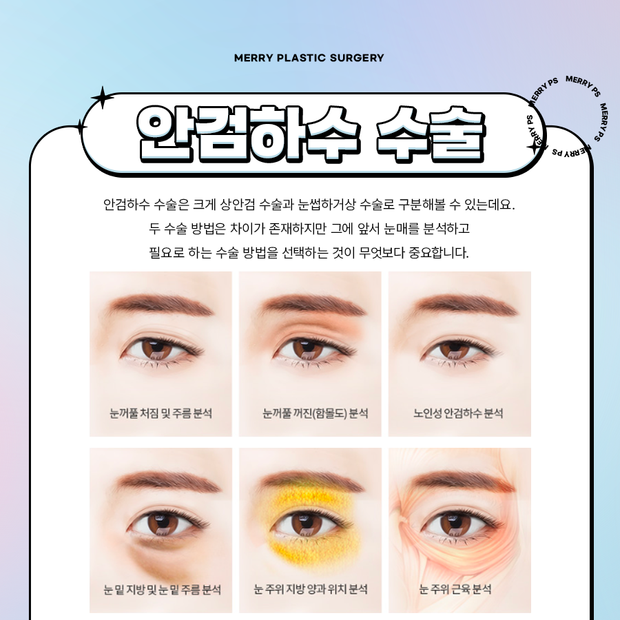 중년 안검하수 수술 처짐 정도에 따라 달라지는 방법은? 관련 이미지 3