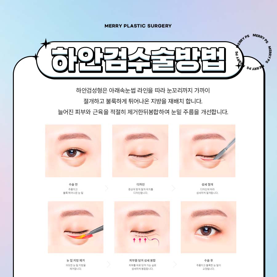 Smooth Bulging Under-Eyes with Lower Blepharoplasty for Middle-Aged Eyes image 5