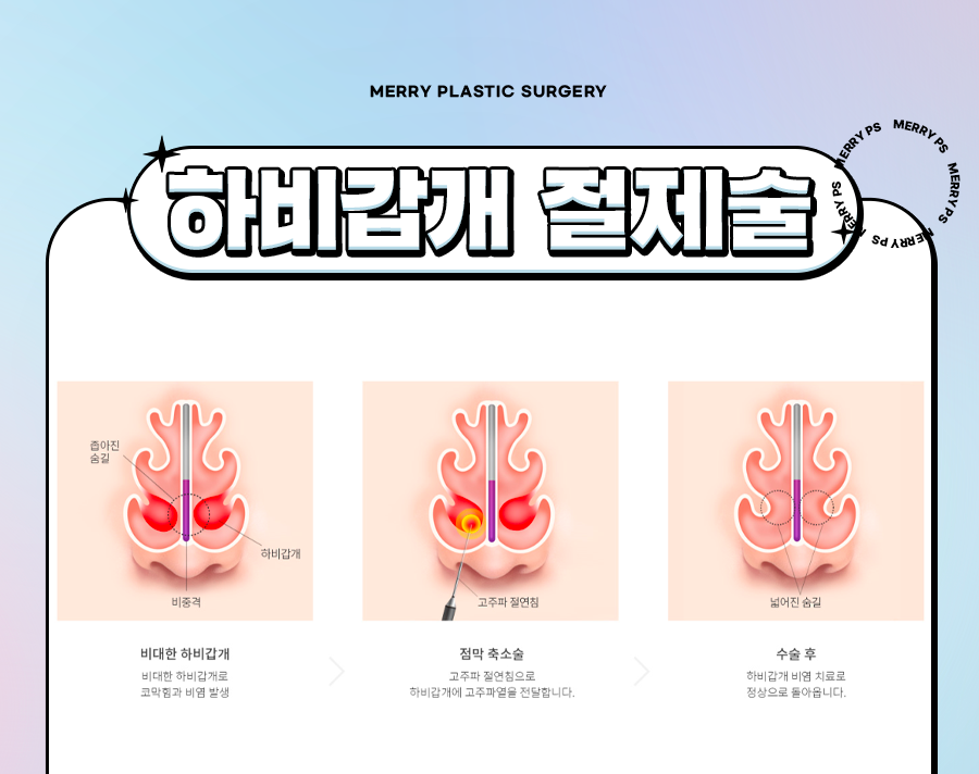 비염 하비갑개절제술 기능 코 성형으로 호흡까지 편한 코 관련 이미지 3