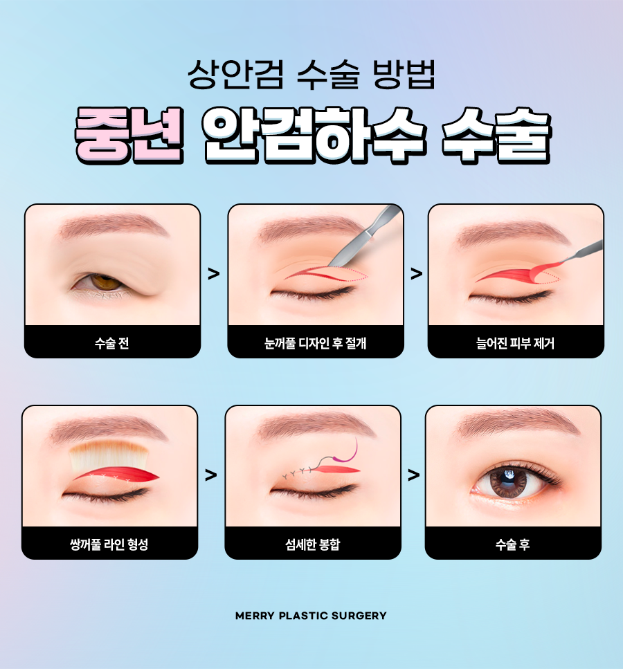 중년 안검하수 수술 처짐 정도에 따라 달라지는 방법은? 관련 이미지 4