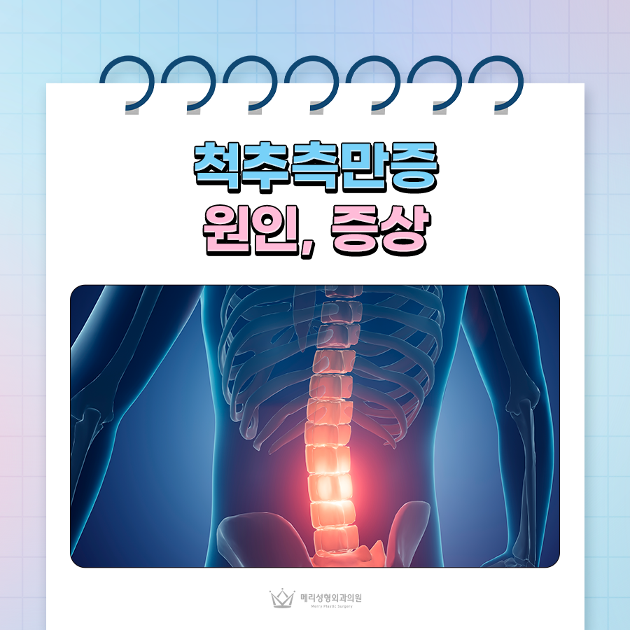 What Are the Causes and Symptoms of Scoliosis, and How Do You Perform a Self-Assessment Test? image 1