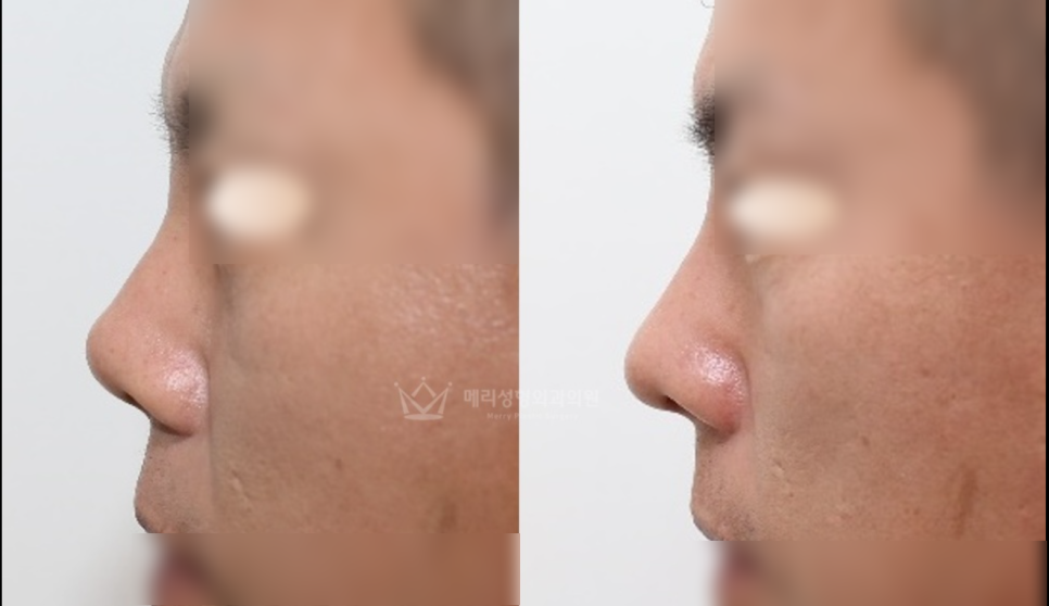 Post-Nose Surgery Pain Management :: How Pain Management Affects Recovery and Surgical Results, How Much It Hurts After Surgery, Painkillers After Surgery, Splint Removal, Merocel Removal image 3