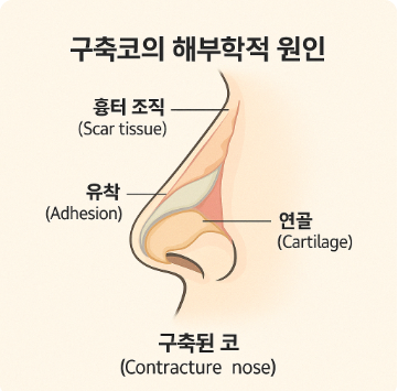 구축코/코재수술 :: 메리말랑주사(재생주사)로 구축을 완화 후 코재수술을 하면 결과가 달라집니다. 관련 이미지 4