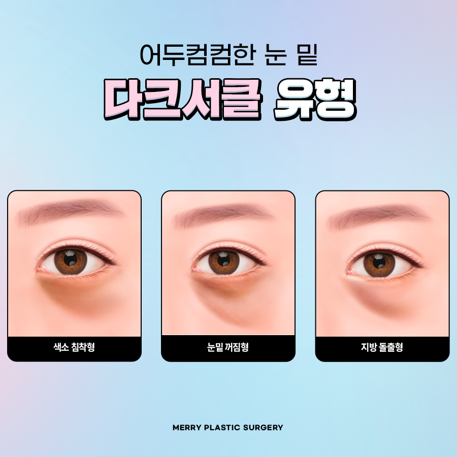 압구정 다크서클 수술, 눈 밑 그늘 유형에 따라서 관련 이미지 2