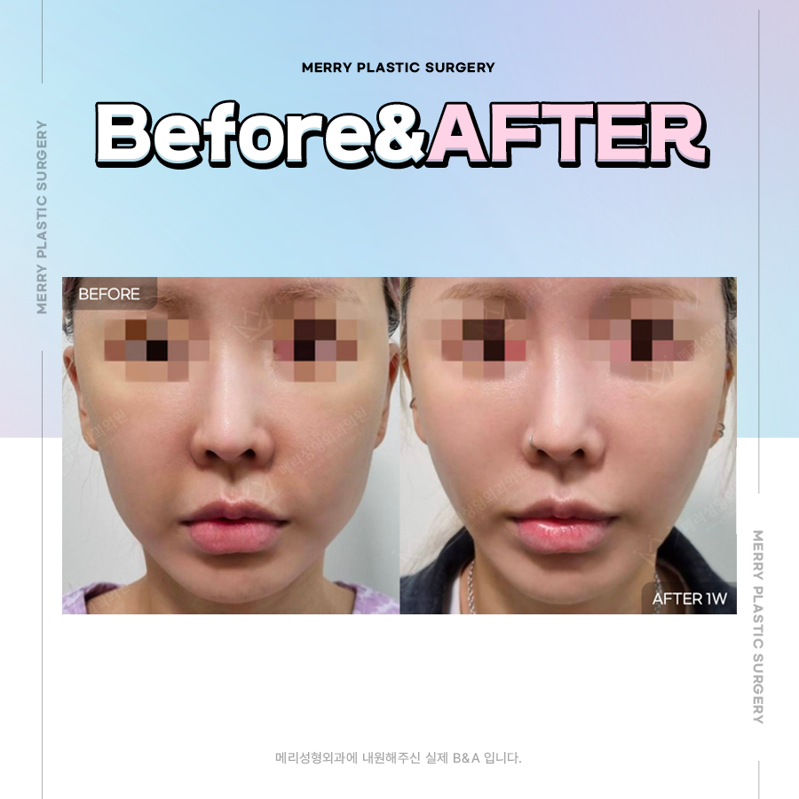 신사역 실루엣소프트 잘하는곳 볼륨감과 탄력감을 동시에 관련 이미지 6
