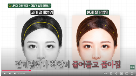 내시경 이마거상술, 흉터 걱정 없이 젊음을 되찾으세요! 관련 이미지 4