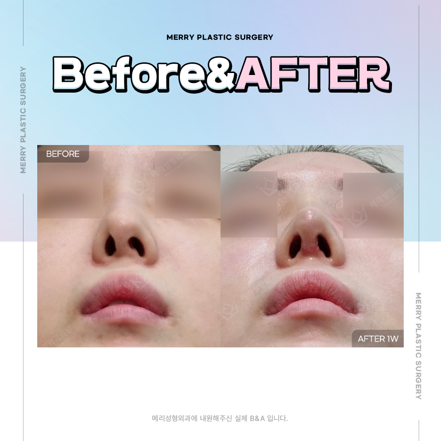 Nose Surgery Materials Near Apgujeong Station: Achieve Stable Results with Your Own Tissue! image 5